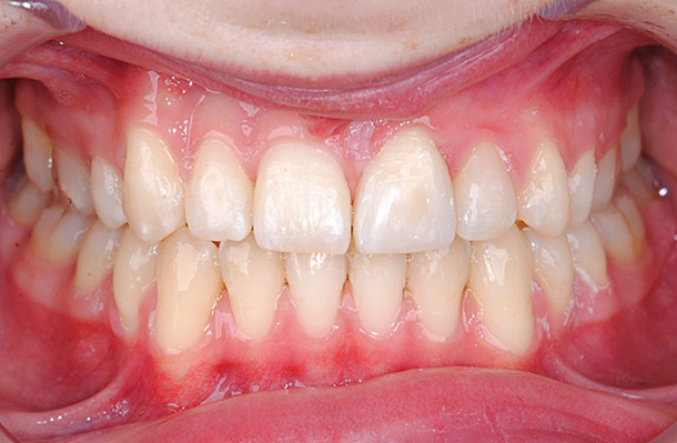 lichte afwijkende gingivale contour 