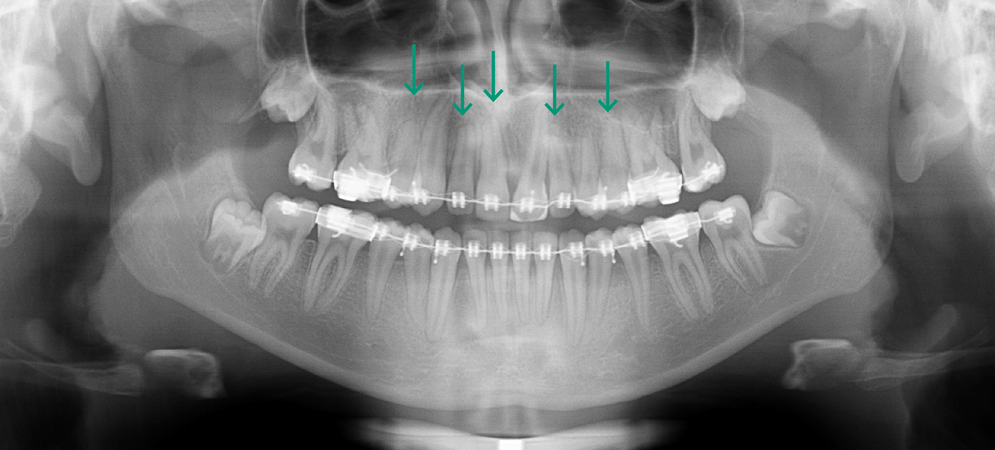 röntgenologisch beeld voor voltooiing orthodontische behandeling