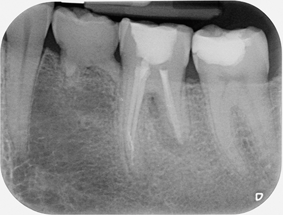 Gebitselement 36 na endodontische behandeling