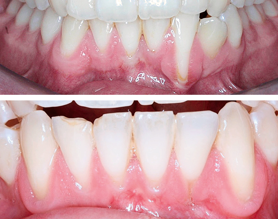 Onderkaak voor en 4,5 jaar na orthodontische behandeling van gingivarecessie