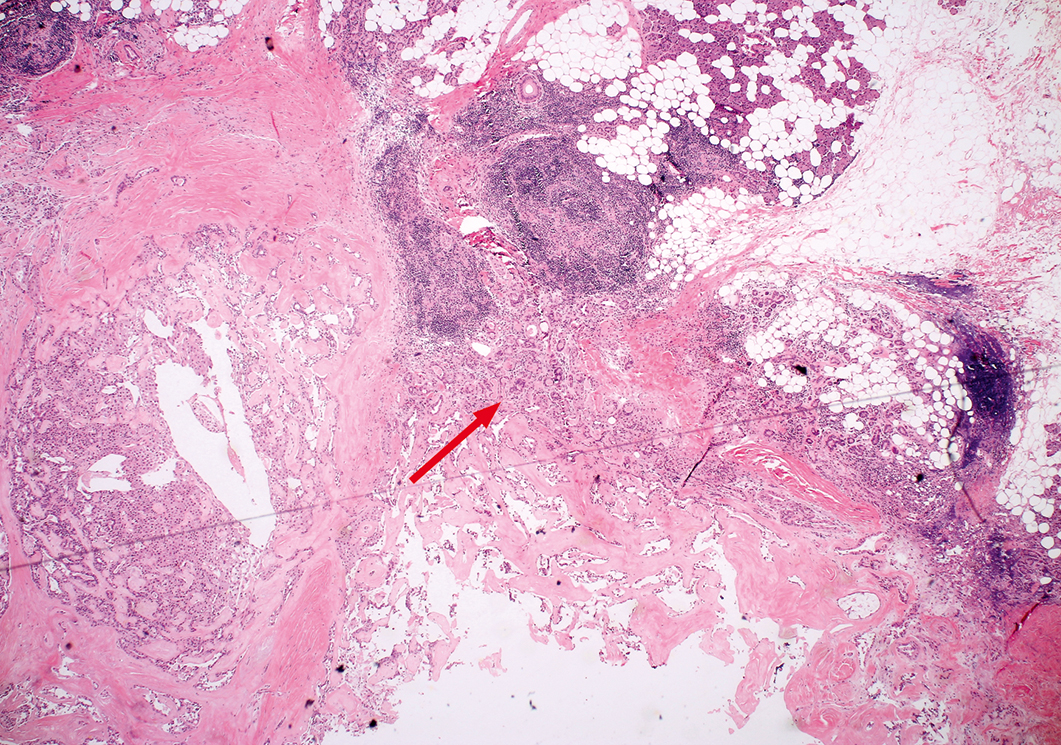 Histologisch beeld parotistumor 1