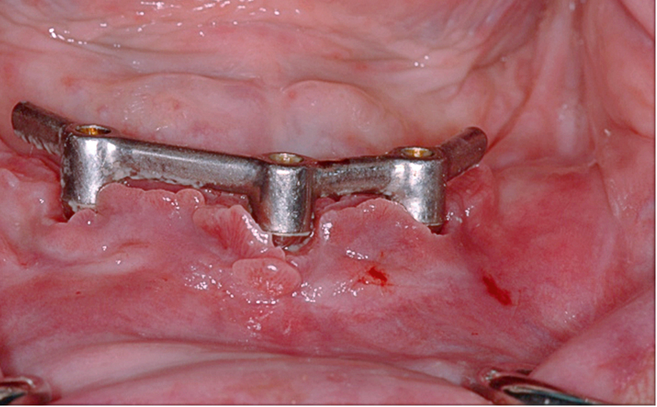 Hyperplasie van gingiva onder mesostructuur