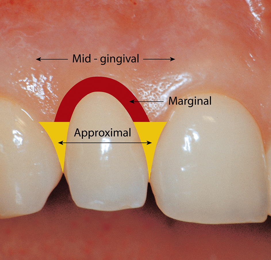 gebieden waar aantal gingiva-abrasiën wordt gemeten