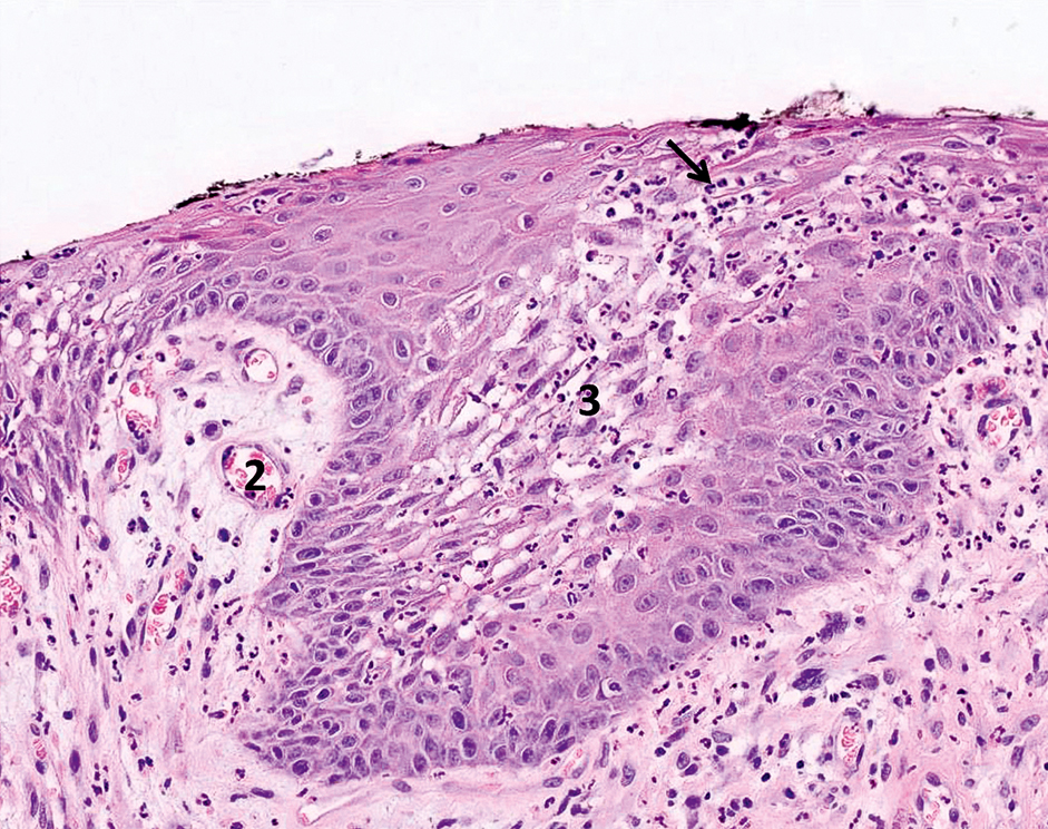 Spongiose, exocytose en gedilateerde vaatjes