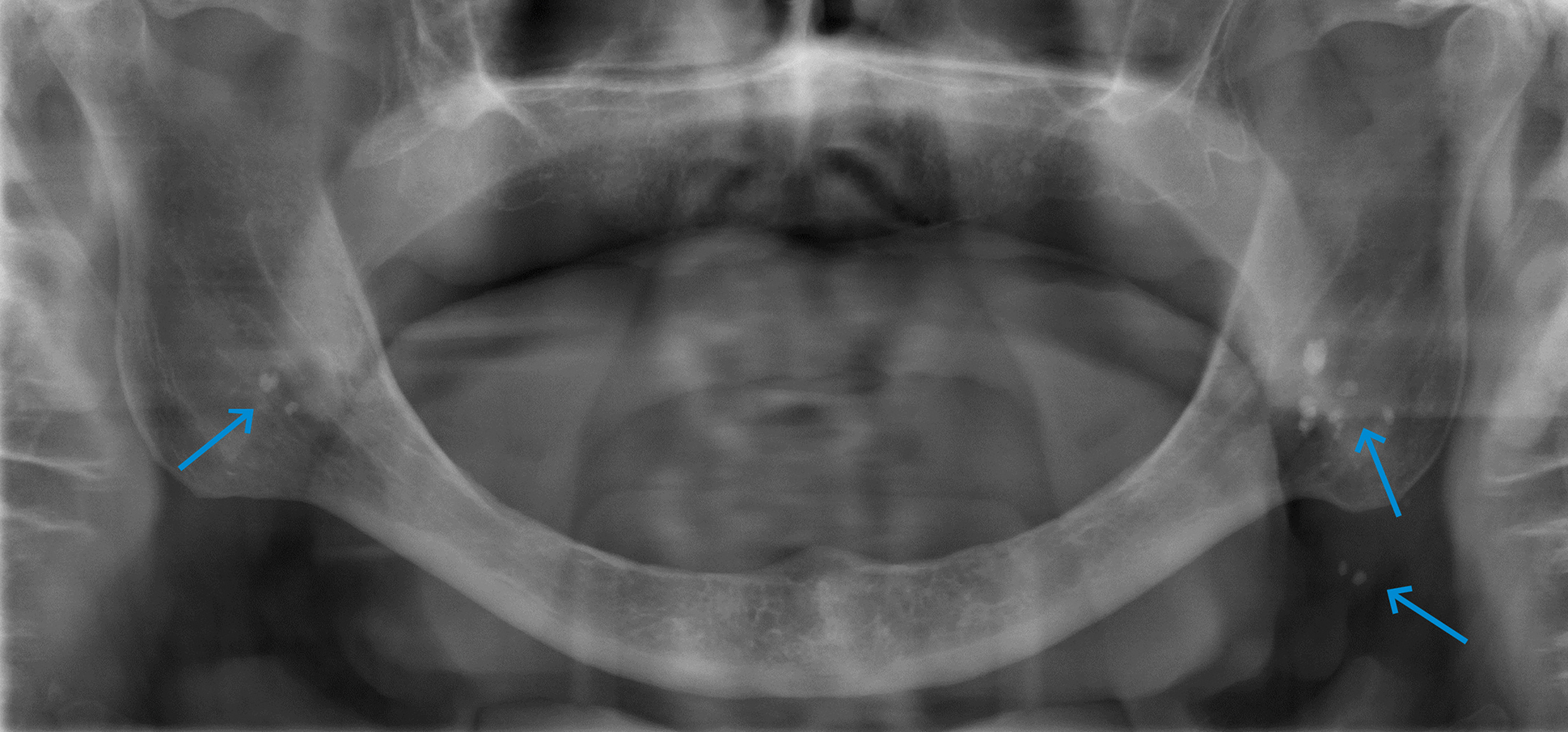 opt met multipele, dubbelzijdig voorkomende opaciteiten over ramus mandibulae