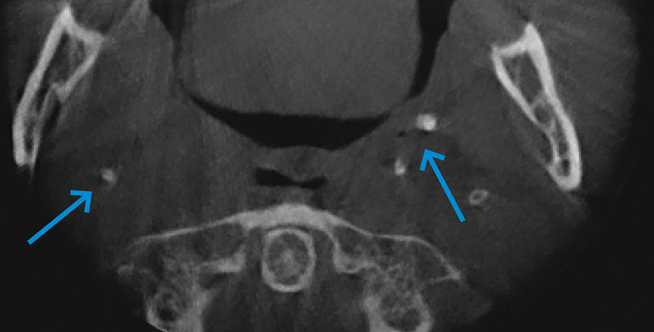axiale doorsnede CBCTscan met voor tonsilloliten verdachte structuren