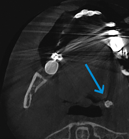 CT-scan toont tonsilloliten aan