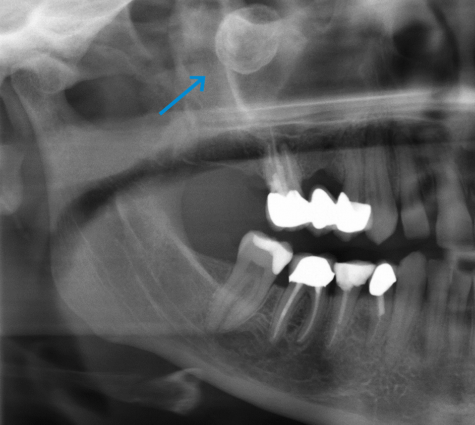 Scherp begrensde opaciteit ter plekke van de rechter sinus maxillaris