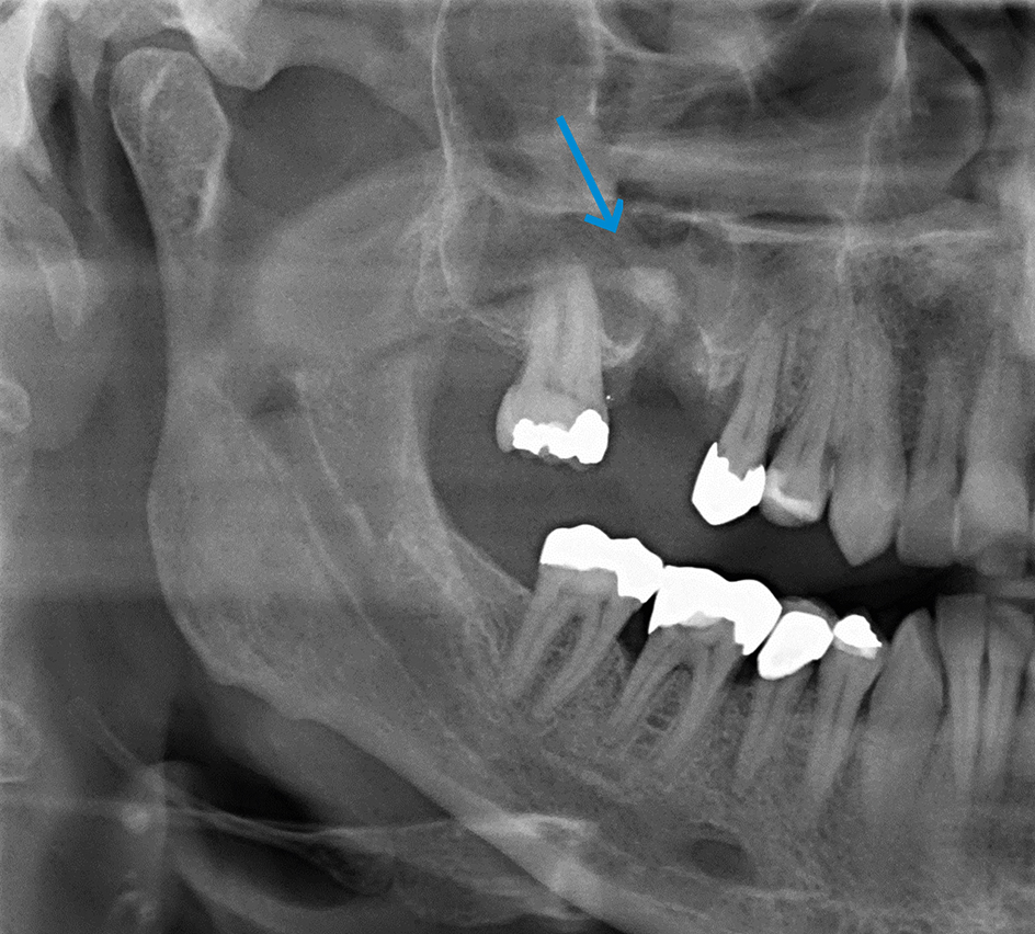 opaciteit in de rechter sinus maxillaris in de regio van gebitselement 16
