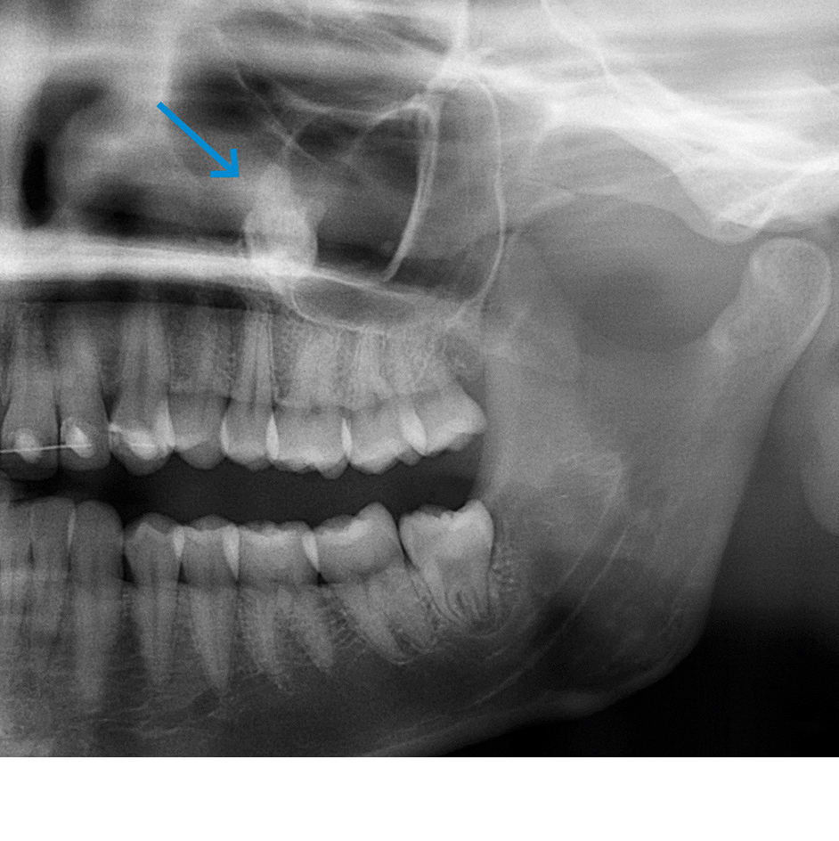 Opaciteit ter plekke van de linker sinus maxillaris