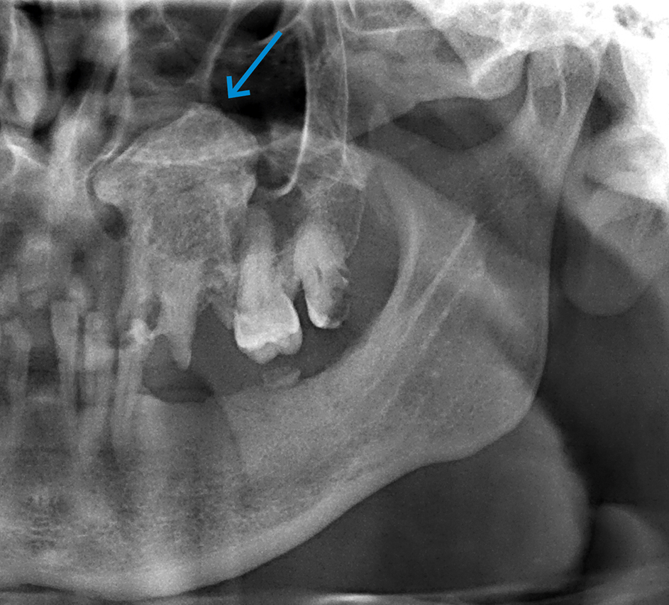 Uitgebreide scherp begrensde opake afwijking linker sinus maxillaris