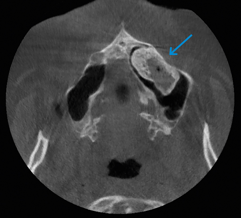 opake afwijking blijkt ossificerend fibroom