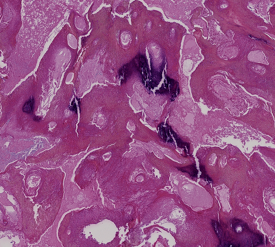 Histologisch beeld van pilomatrixoma