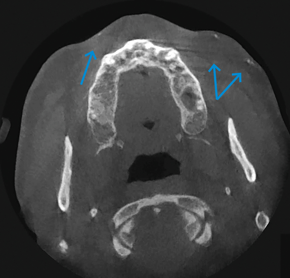 calcinosis cutis