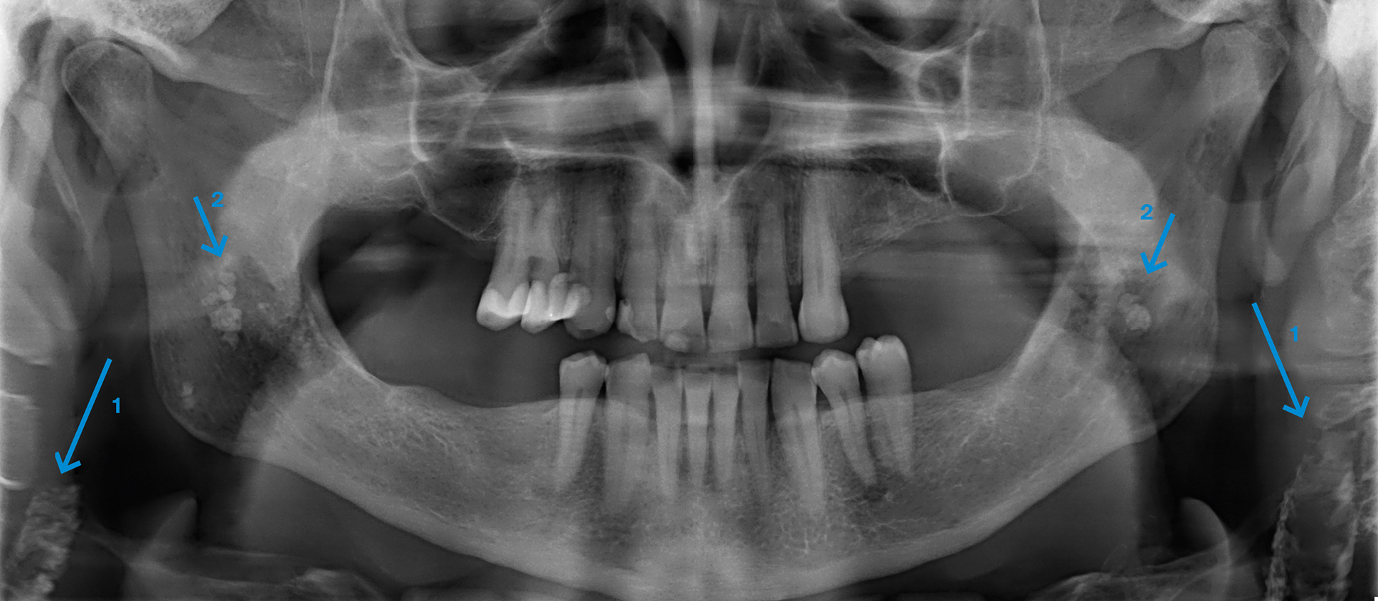 verkalkingen van carotiden en  tonsillolithen