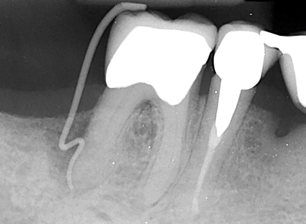 wortelkanaalbehandeling bij parodontitis apicalis