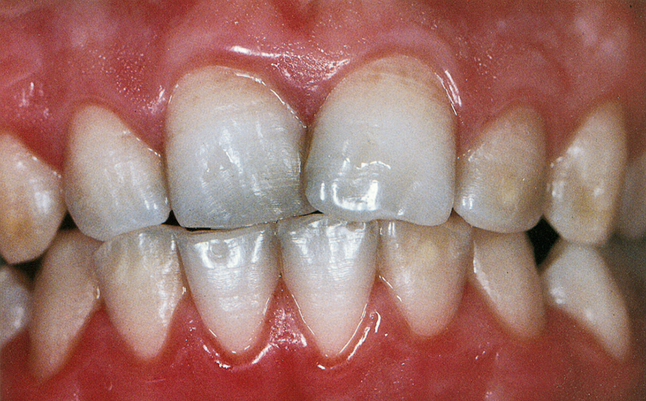 Coeliakie en tandheelkunde