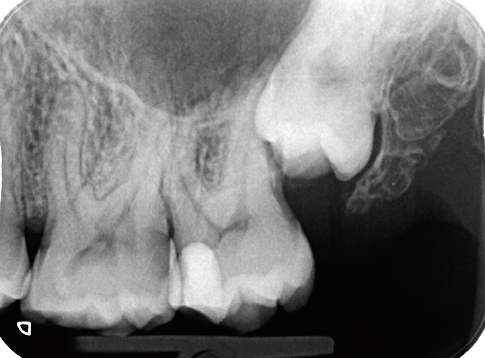 Endodontologie in beweging: nieuwe concepten, materialen en technieken 2. Conebeamcomputer­tomografie in de endodontische diagnostiek en behandelplanning