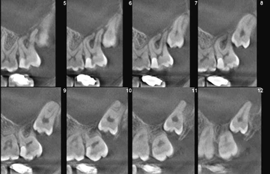 Endodontologie in beweging: nieuwe concepten, materialen en technieken 2. Conebeamcomputer­tomografie in de endodontische diagnostiek en behandelplanning