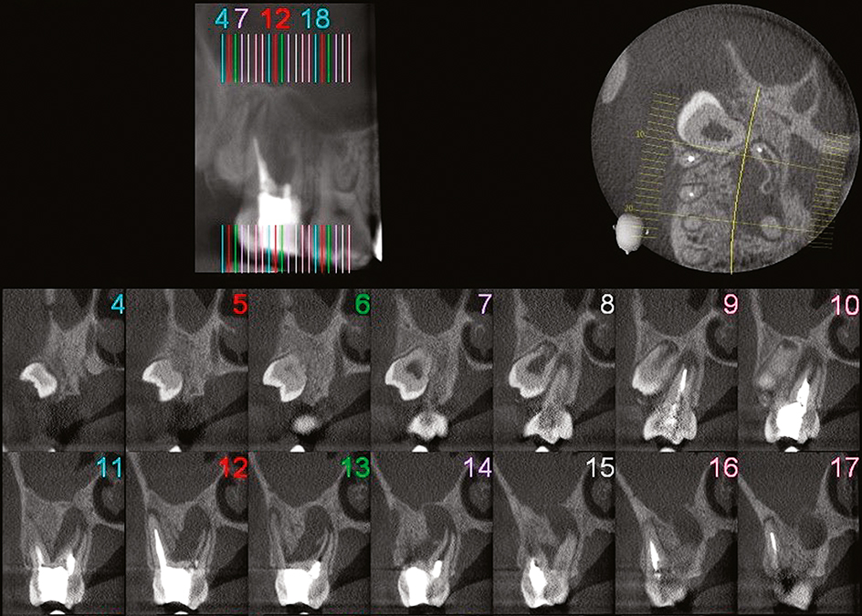 Endodontologie in beweging: nieuwe concepten, materialen en technieken 2. Conebeamcomputer­tomografie in de endodontische diagnostiek en behandelplanning