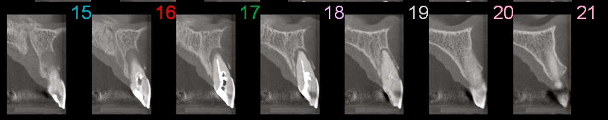 Endodontologie in beweging: nieuwe concepten, materialen en technieken 2. Conebeamcomputer­tomografie in de endodontische diagnostiek en behandelplanning