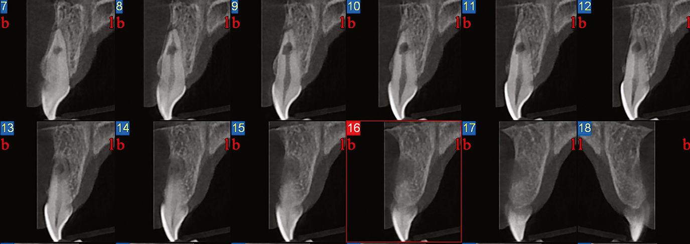 Endodontologie in beweging: nieuwe concepten, materialen en technieken 2. Conebeamcomputer­tomografie in de endodontische diagnostiek en behandelplanning