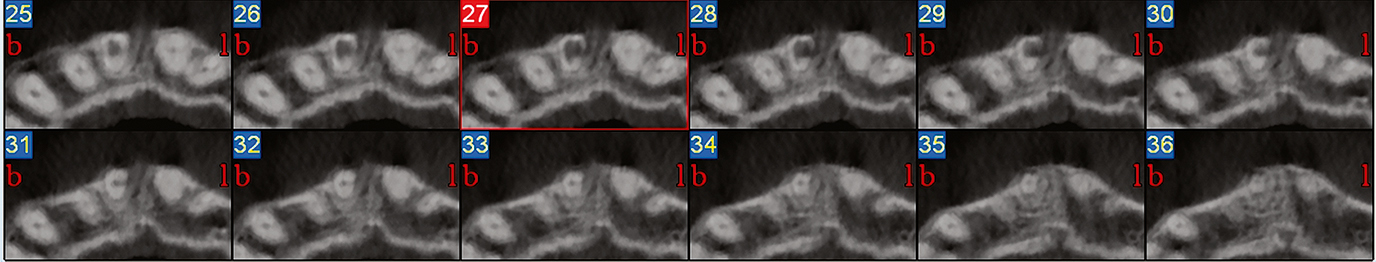 Endodontologie in beweging: nieuwe concepten, materialen en technieken 2. Conebeamcomputer­tomografie in de endodontische diagnostiek en behandelplanning