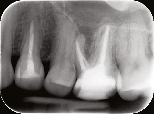 Endodontologie in beweging: nieuwe concepten, materialen en technieken 2. Conebeamcomputer­tomografie in de endodontische diagnostiek en behandelplanning