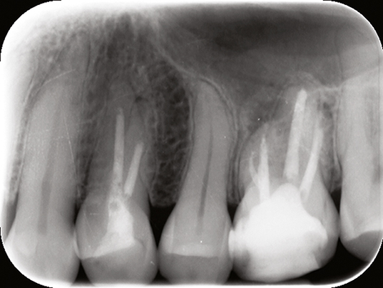 Endodontologie in beweging: nieuwe concepten, materialen en technieken 2. Conebeamcomputer­tomografie in de endodontische diagnostiek en behandelplanning