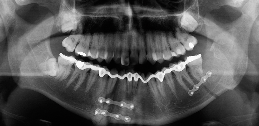 Standscorrectie van de mandibula met de driedimensionaal geprinte dentale spalksitu.