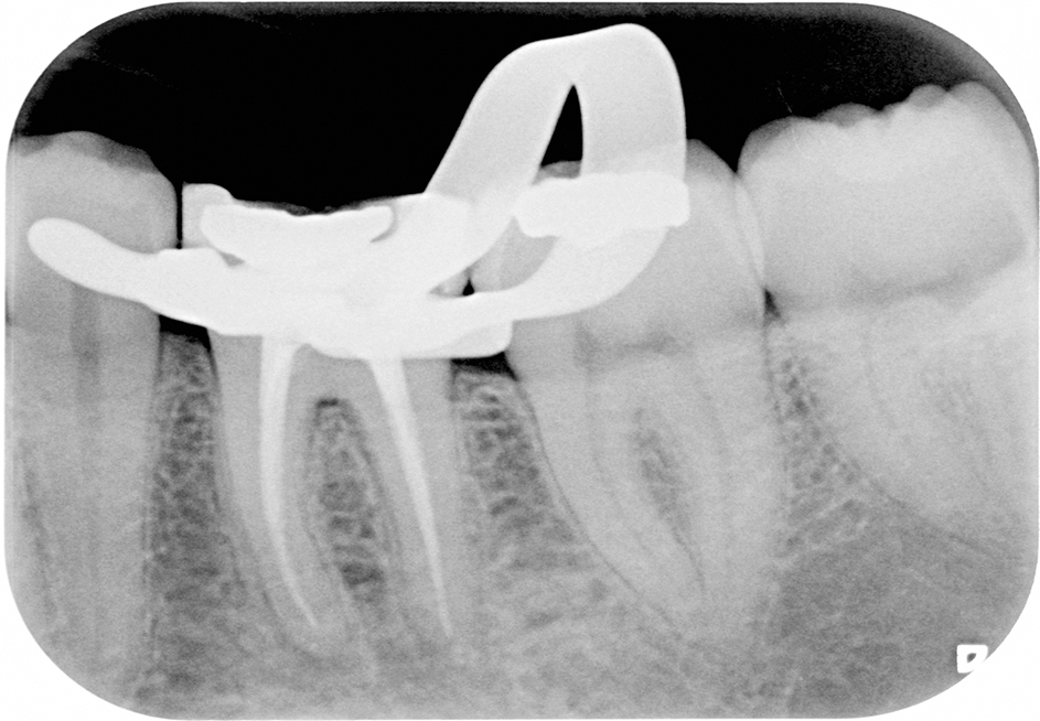 Na endodontische behandeling: periapicale radiolucentie