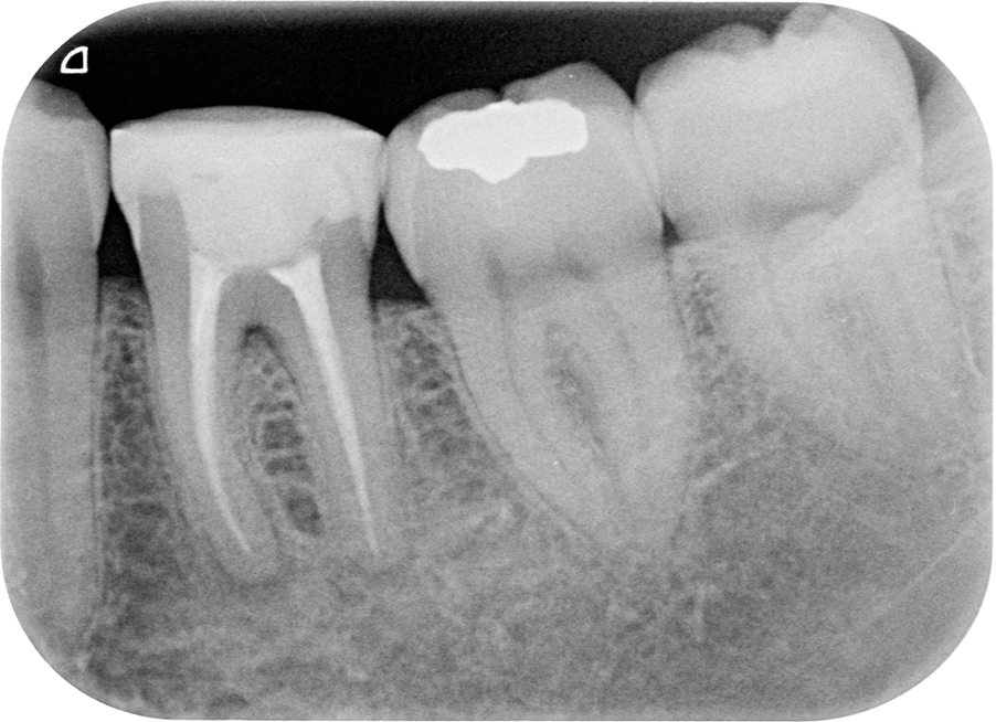 Twee jaar na endodontische behandeling: periapicale radiolucenties