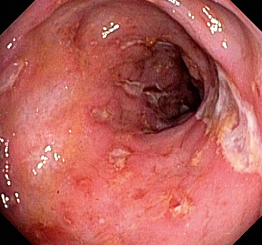 Mucosa met ulceraties