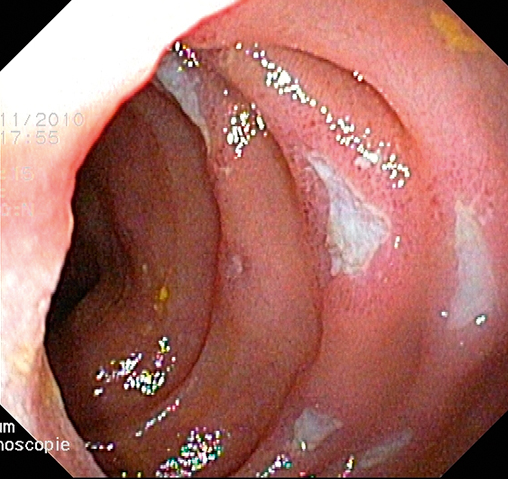 Skip lesions in het terminale ileum