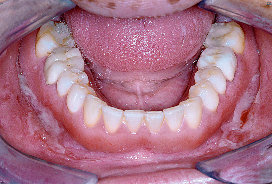 Lineaire ulceratie van het buccale vestibulum