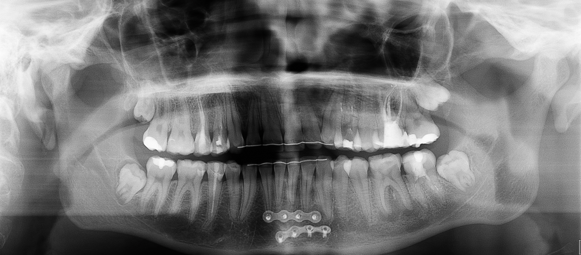 Panoramische röntgenopname voor autotransplantatie