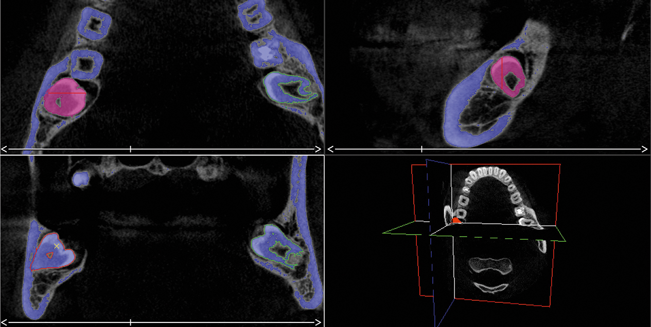 CBCT ten behoeve van preoperatieve planning