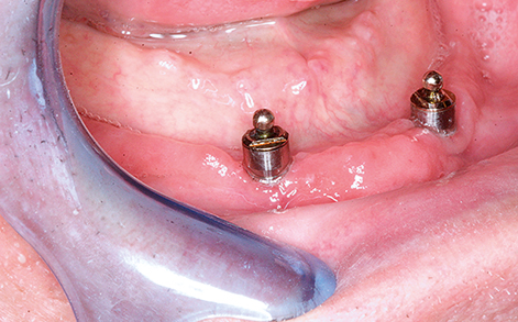 Peri-implantaire gezondheid bij 75-plussers met een overkappingsprothese op implantaten in de onderkaak