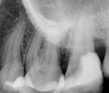 Endodontologie in beweging: nieuwe concepten, materialen en technieken 1. Hydraulische calciumsilicaatcementen