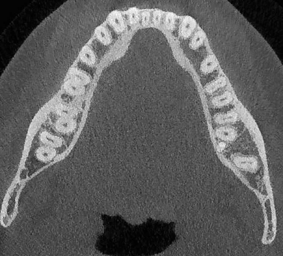 Toegenomen dikte corticale bot