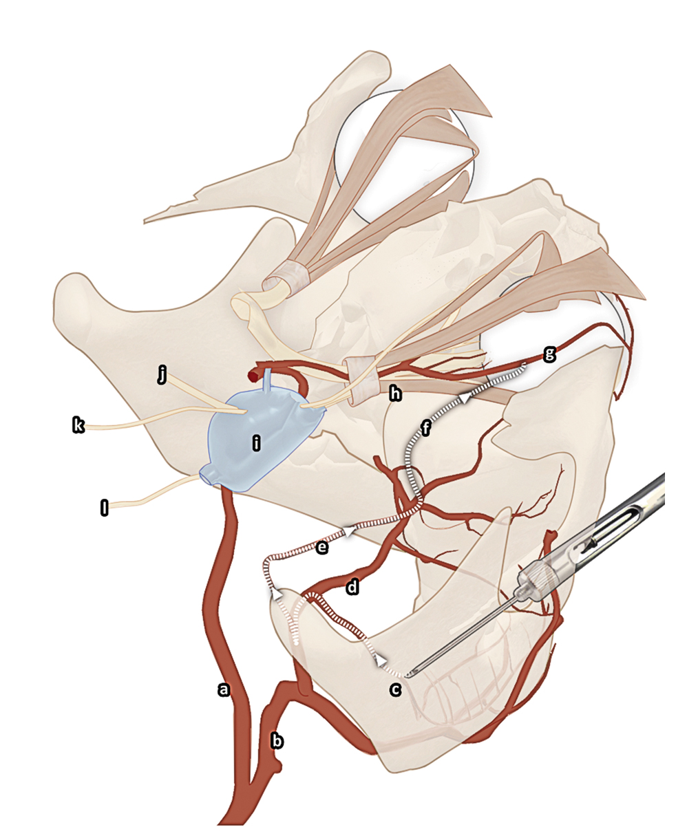 Hypothetische pathologische arteriële route van anestheticum