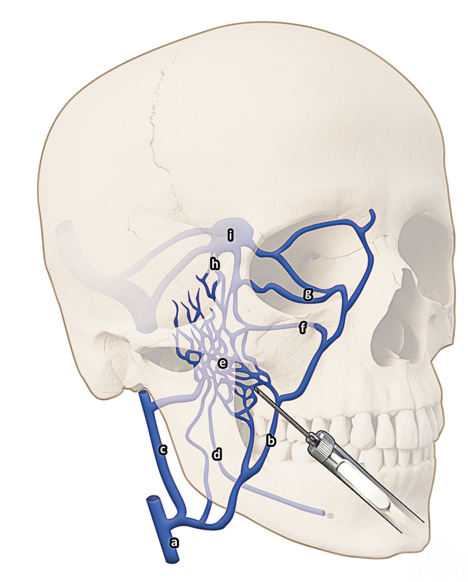 Hypothetische pathologische veneuze routes van anestheticum