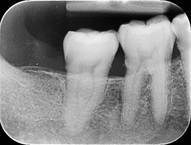  Intraorale röntgenopname van gebitselementen 47 en 46