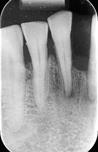  Intraorale röntgenopname van gebitselementen 41 t/m 43
