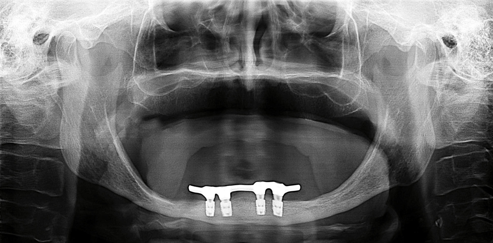 Röntgenopname met 4 implantaten van 6 mm lengte in een edentate onderkaak