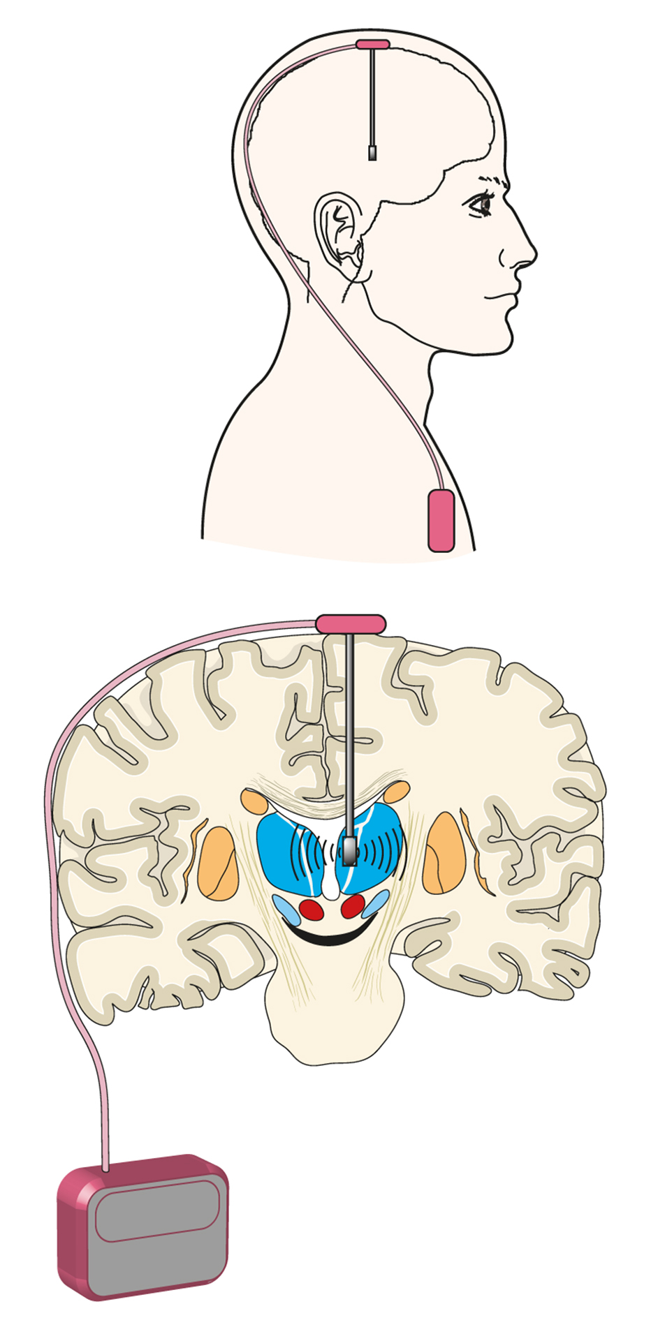 Met neurostimulator verbonden elektrode in de hersenen.