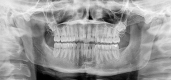 De tandheelkundige röntgenopname: valkuilen en verrassingen