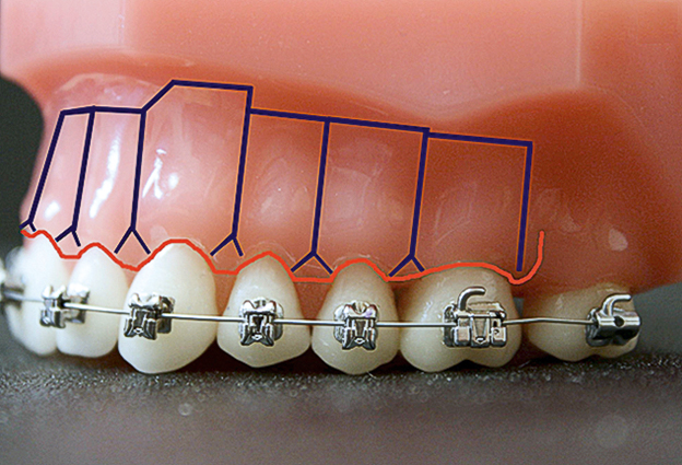 De versnelde orthodontische behandeling