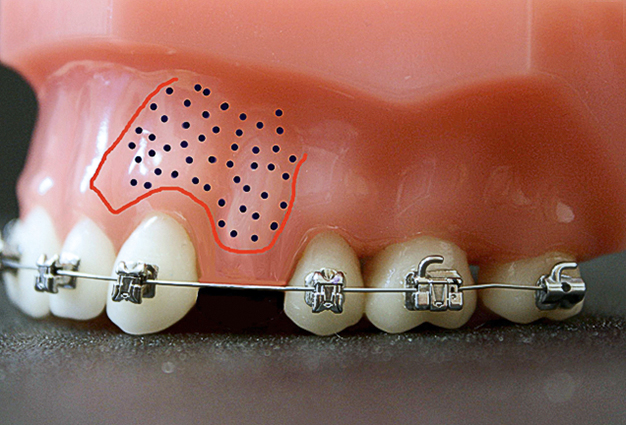 De versnelde orthodontische behandeling