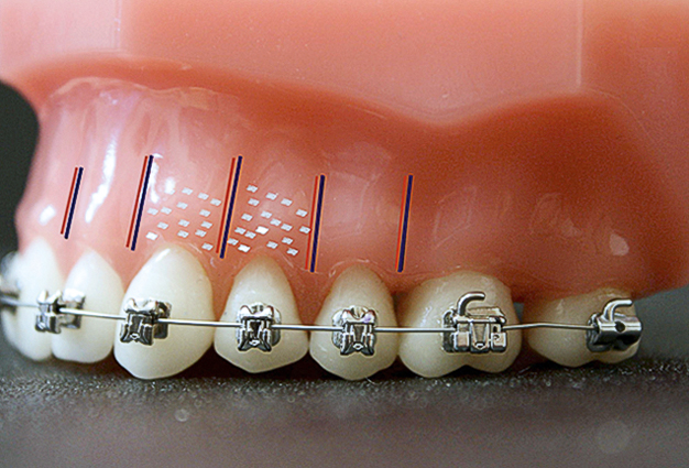 De versnelde orthodontische behandeling